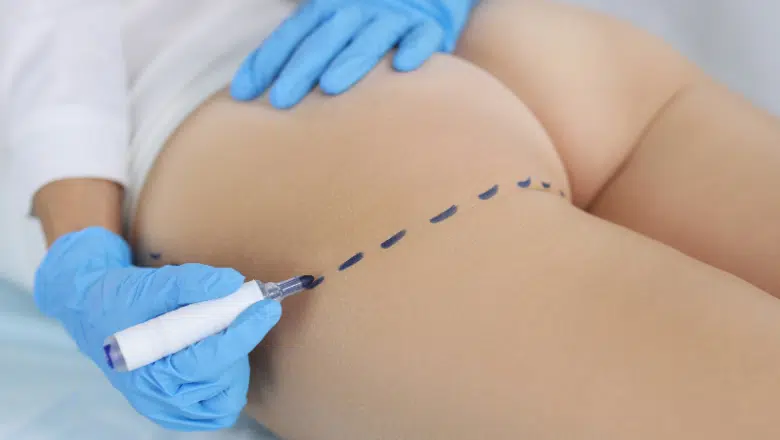 bum injections procedure