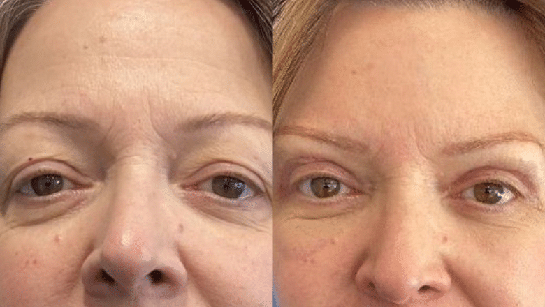 Upper eyelid blepharoplasty before and after 1