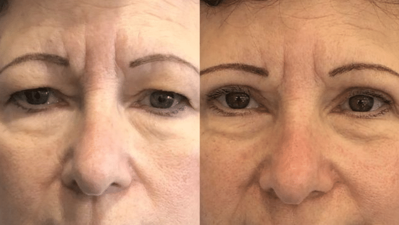 Upper eyelid surgery before and after 2