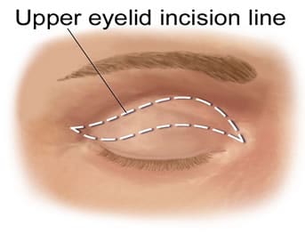 upper blepharoplasty incision