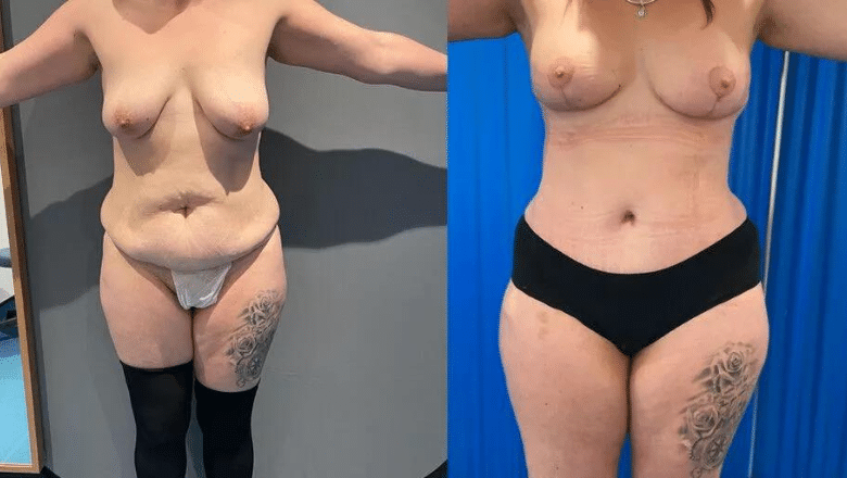 tummy tuck and breast lift before and after