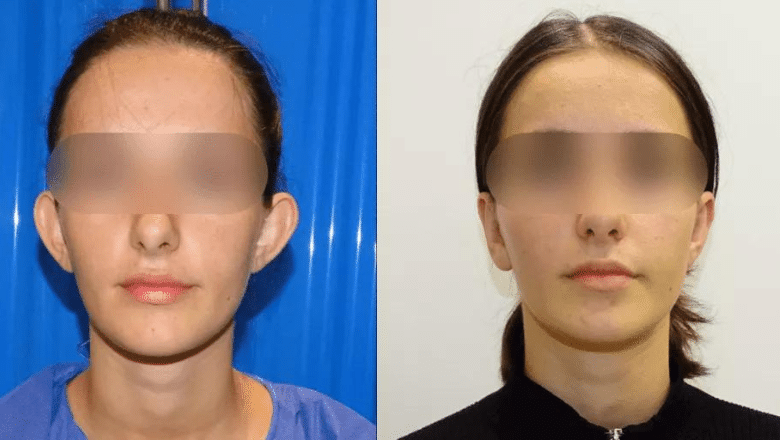 Otoplasty before and after 1