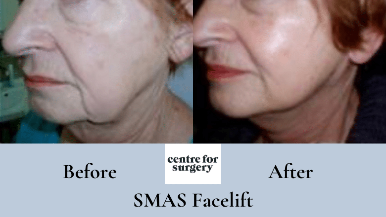 SMAS facelift before and after 7