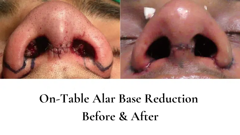 alar base reduction on table before and after