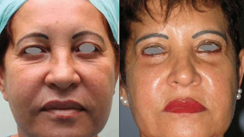 eyelid surgery before and after 4