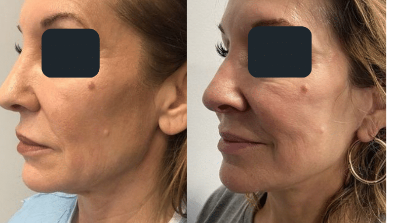mini facelift before and after 2