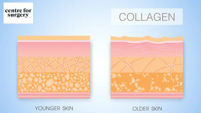 saggy jowls collagen