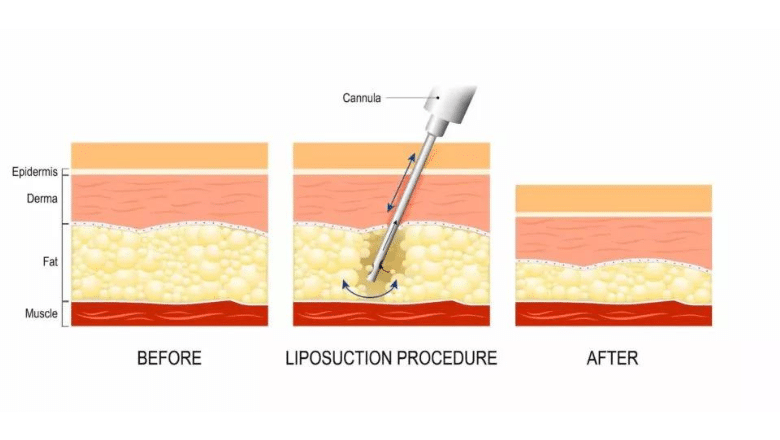 can liposuction remove visceral fat