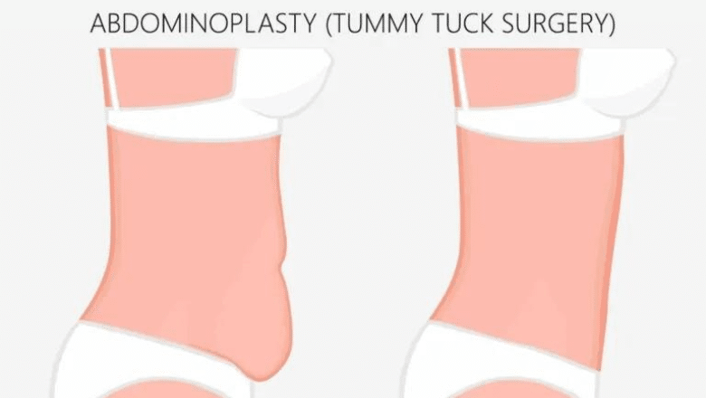 tummy tuck after c section