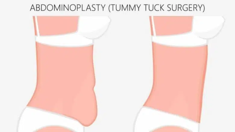 tummy tuck after c section