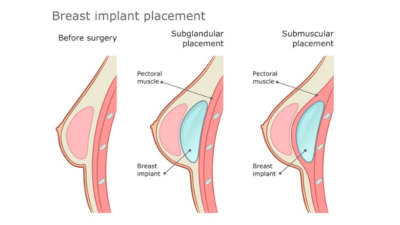 breast implant placement