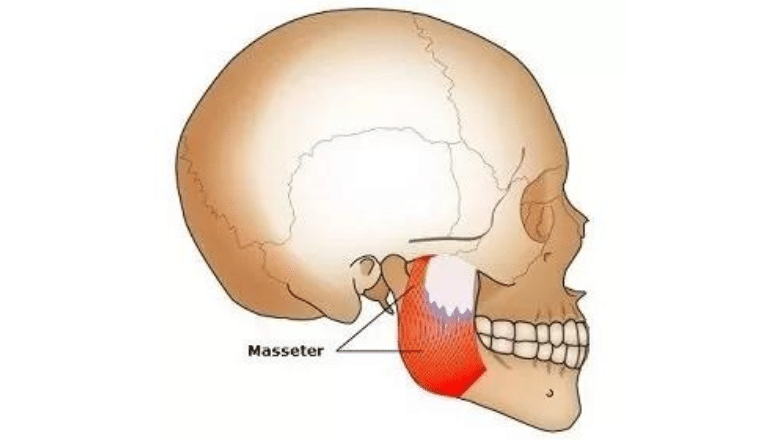 masseter injections jaw slimming