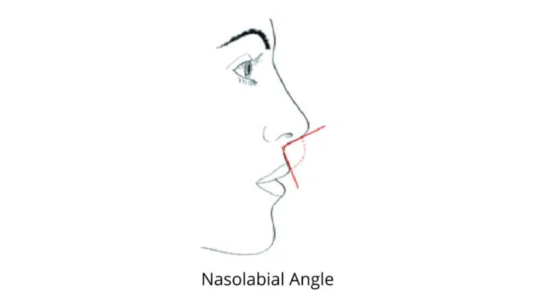 nasolabial angle