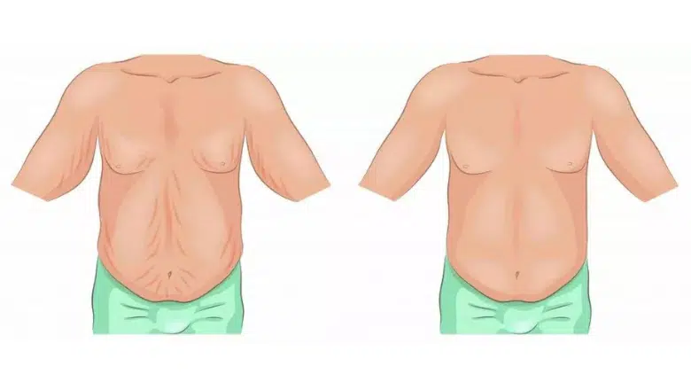 belt lipectomy excess skin removal