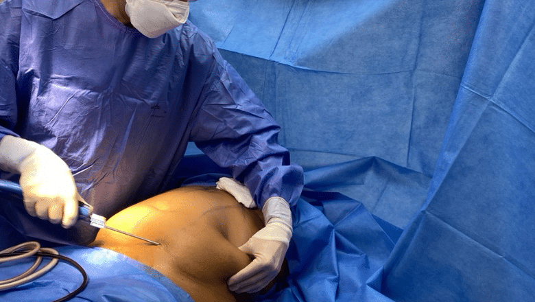 brazilian butt lift procedure at Centre for Surgery