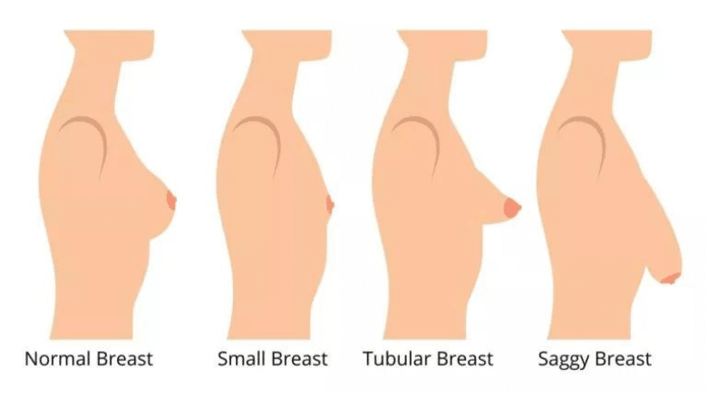 tubular breasts diagram