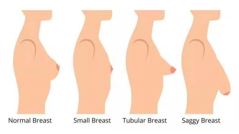 tubular breasts diagram