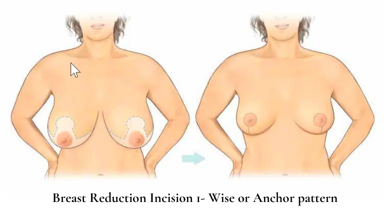 Breast Reduction Incision 1 - Wise or Anchor pattern