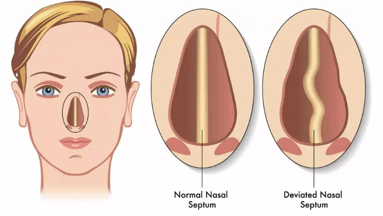 Deviated nasal septum