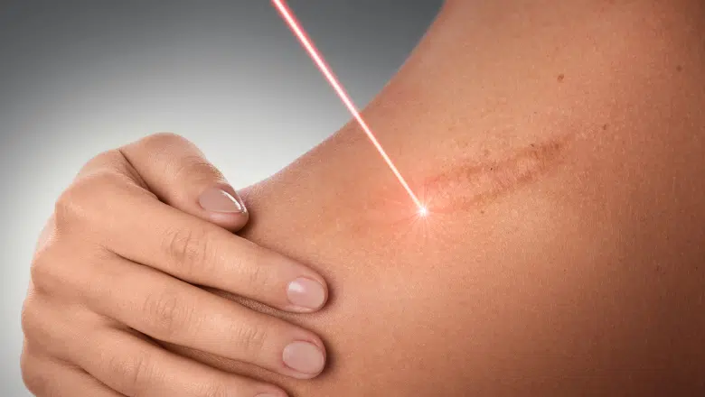 Laser Scar Removal London UK