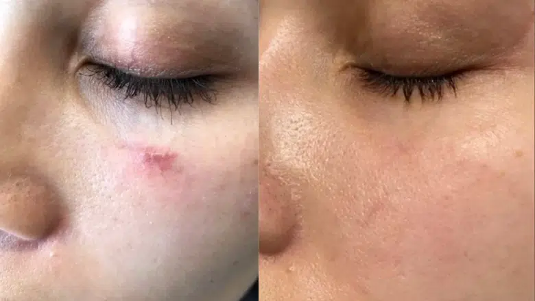 Laser Scar Revision before after 3