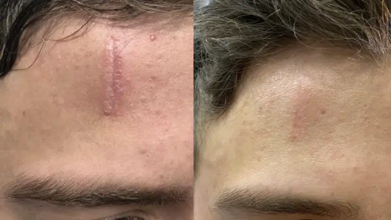 Scar Revision Laser before after 4