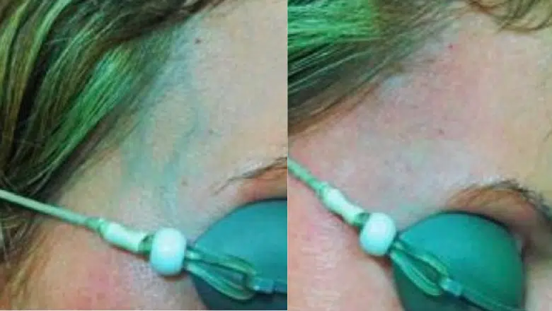 periorbital veins laser removal before after