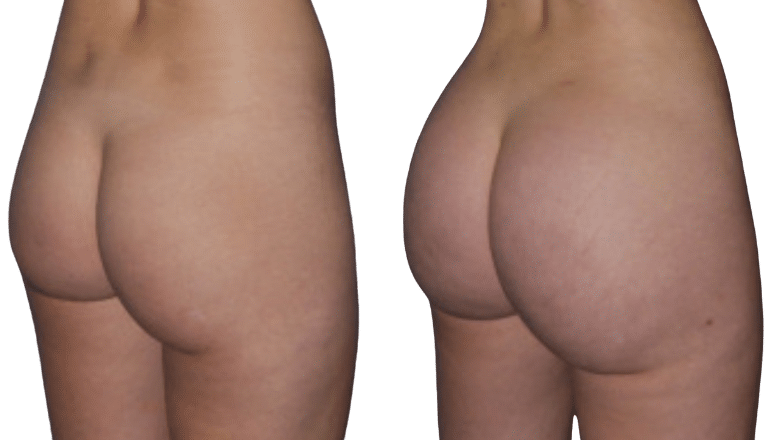 BBL before after 23 side view