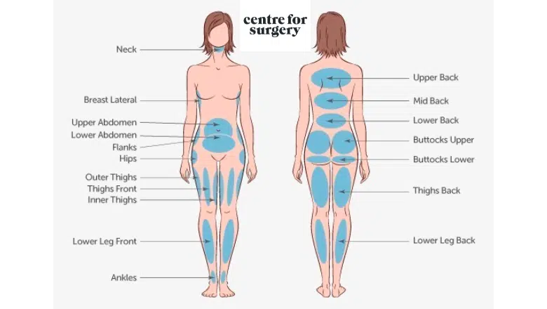 Common Liposuction Areas