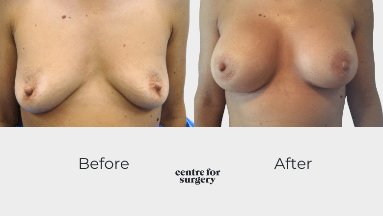 breast uplift implants before after