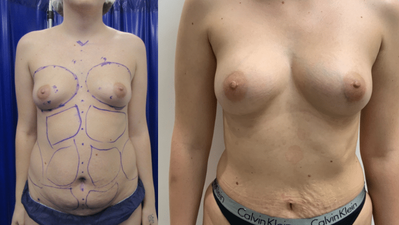 fat transfer to breasts before after 3