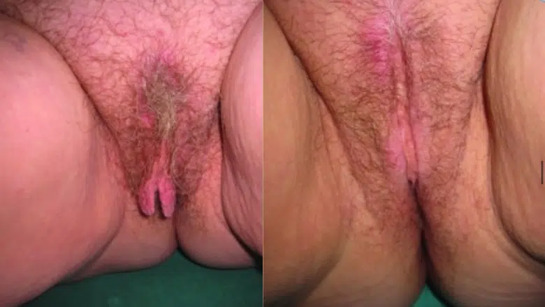 labia minora reduction before after